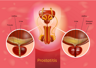 la prostatitis