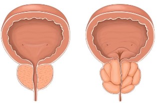 La prostatitis