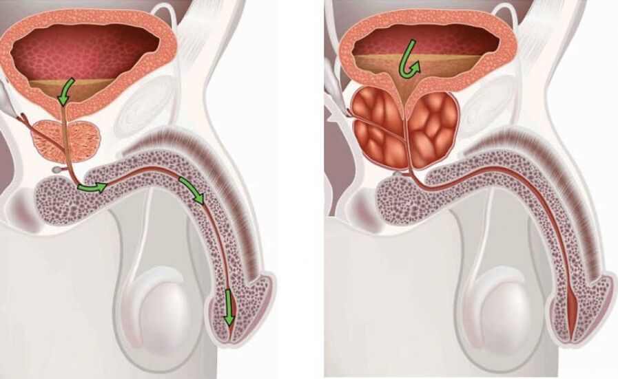 próstata sana y enferma en hombres