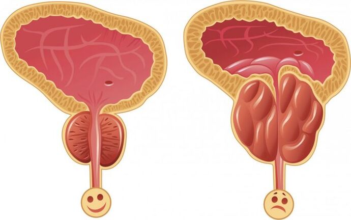 próstata sana e inflamada con prostatitis