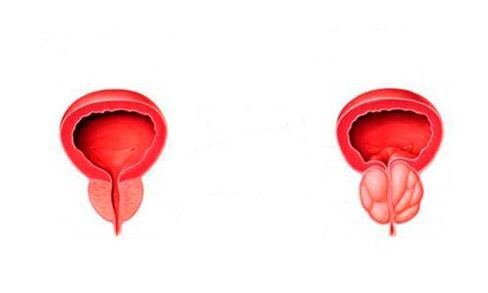 próstata sana e inflamada con prostatitis