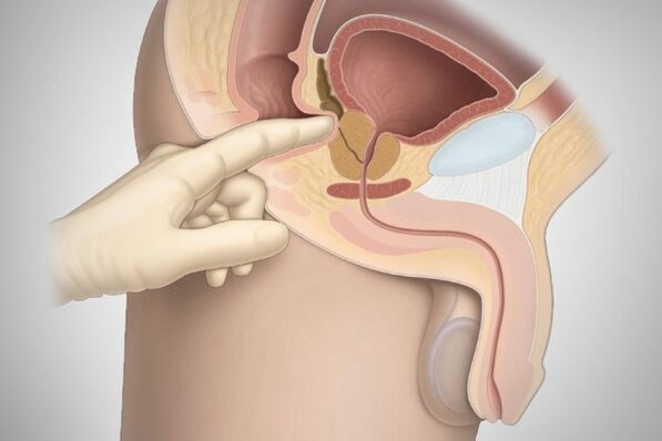 Masaje de próstata para la prostatitis bacteriana. 