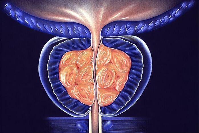 síntomas y tratamiento de la prostatitis