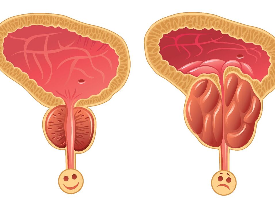 Próstata sana y congestión prostática con prostatitis congestiva