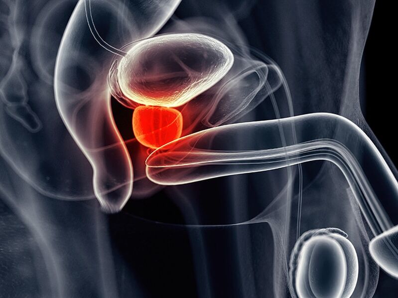 Inflamación de la próstata que acompaña a la prostatitis crónica.