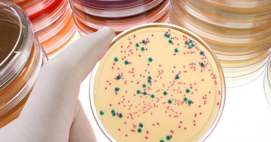 La prostatitis crónica bacteriana se detecta analizando la orina y las secreciones prostáticas.