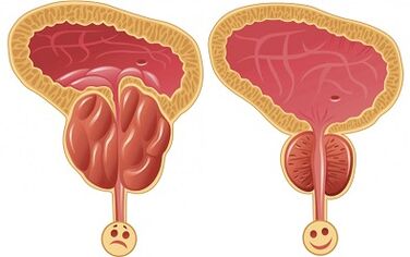 cómo actúa Prostalix para la prostatitis antes y después del tratamiento